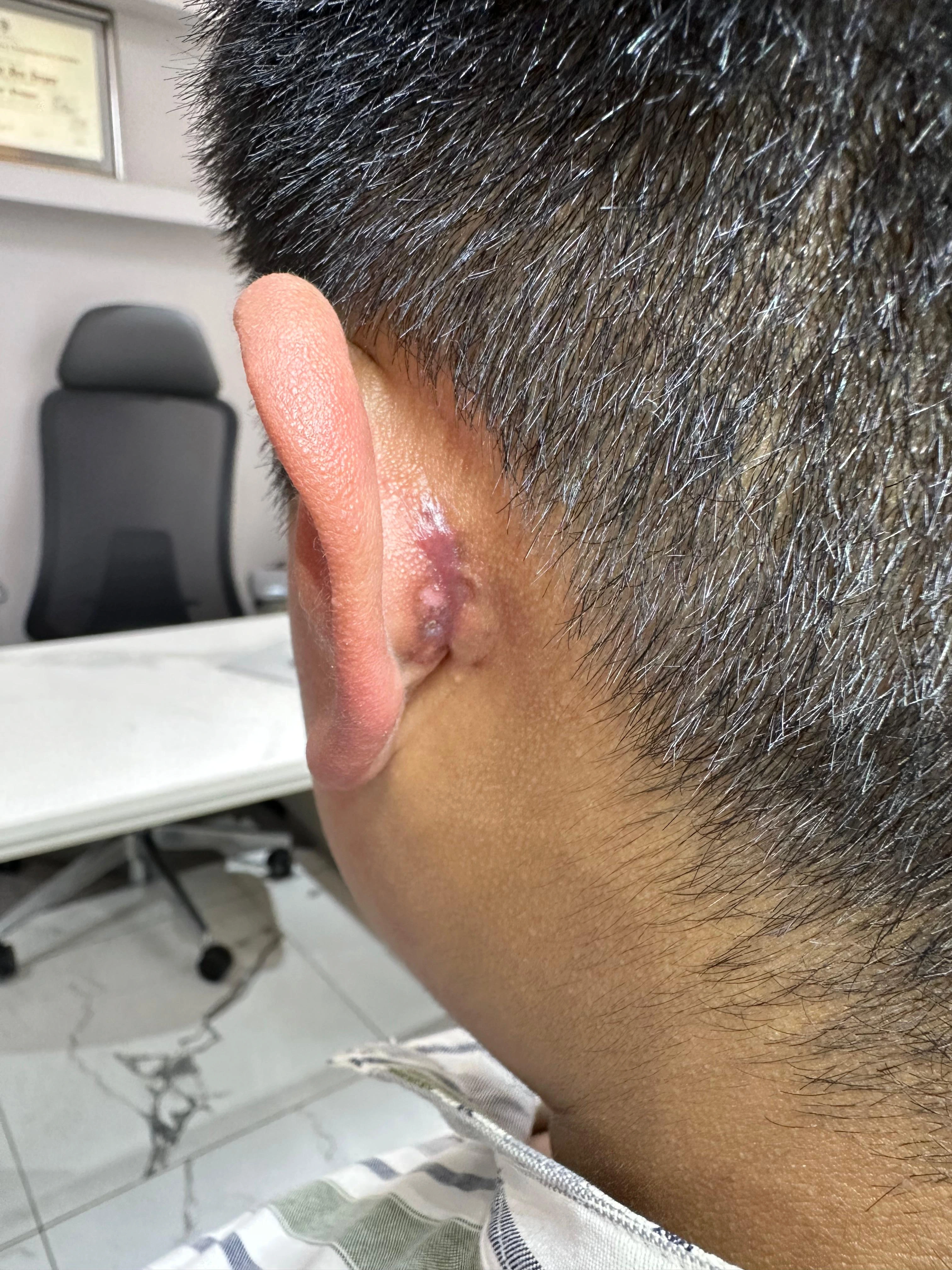 Tratamiento de Queloides - Después